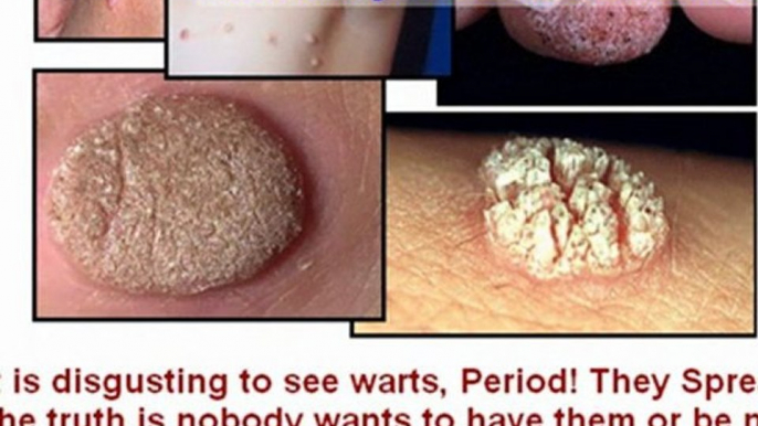 remove skin tags yourself, best wart remover, skin tag removal home remedy, skin tag removal at home , how to remove skin tags, how to get rid of skin tags, skin tags how to remove , skin tag remover, how to get rid of a wart