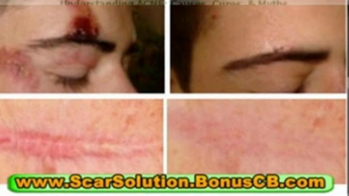 treatment for scars - treating acne scars - how to remove scars