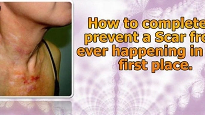 how to remove scars - how to get rid of acne scars fast - best scar treatment