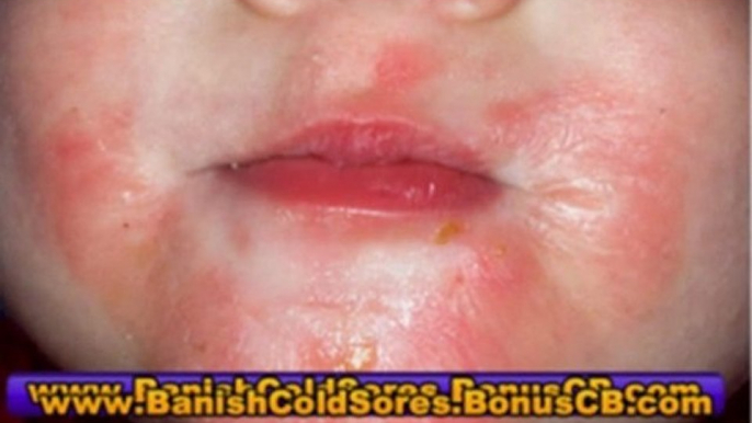 cold sore remedies - cold sore treatment - cold sore cures