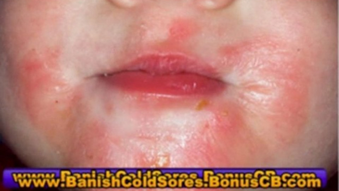 cold sore home remedies - how to treat cold sores - how to treat a cold sore