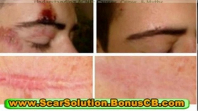 chicken pox scar - chicken pox scars - reduce acne scars - acne scars removal