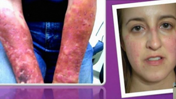 lupus home remedies - lupus in children - lupus lupus