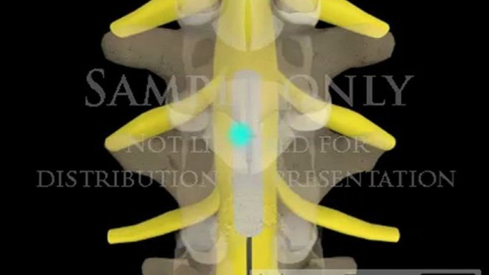 Lumbar Spinal Cord Neuro-stimulation paddle electrode pain management animations