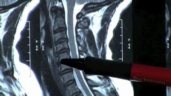 Neck Pain MRI scan Atlanta, & Spinal decompression physical therapy, chiropractor treatment