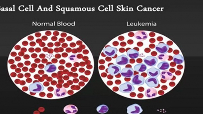 Melanoma Excision & Skin Cancer Treatment - Skin Cancer Los Angeles