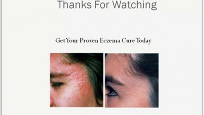 Eczema Natural Remedies: The Best Eczema Cure