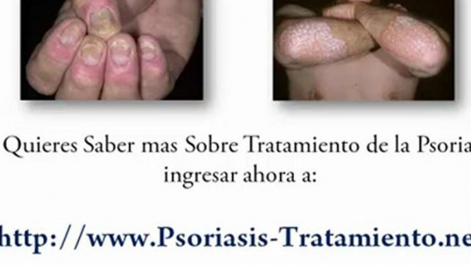 Psoriasis-Tratamiento - Tópicos Contra la psoriasis