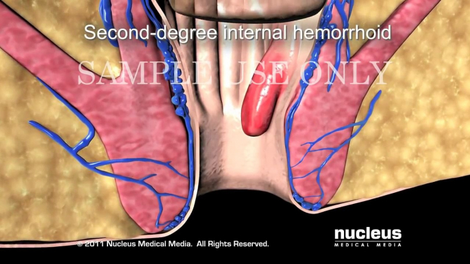 Hemorrhoidectomy (Hemorrhoid Surgery)