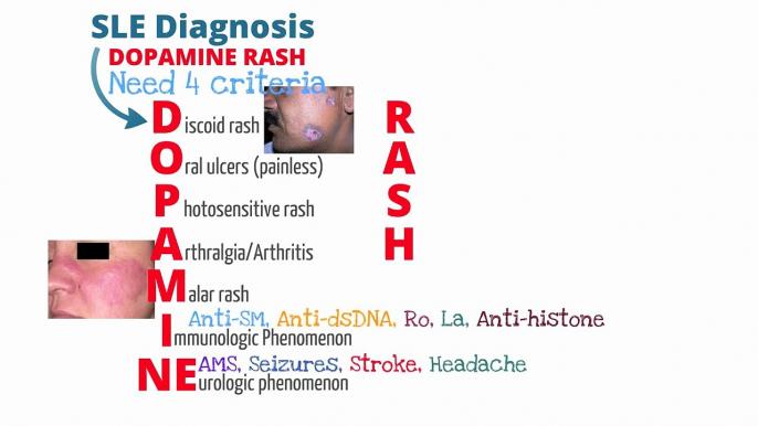 Medical School - Systemic Lupus Erythematosus (SLE)