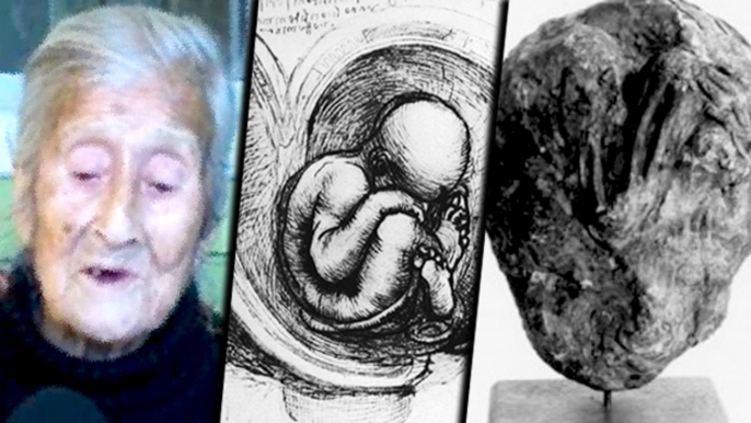 Mummified Fetus In 92-Year Old Chilean Grandma | Shocking