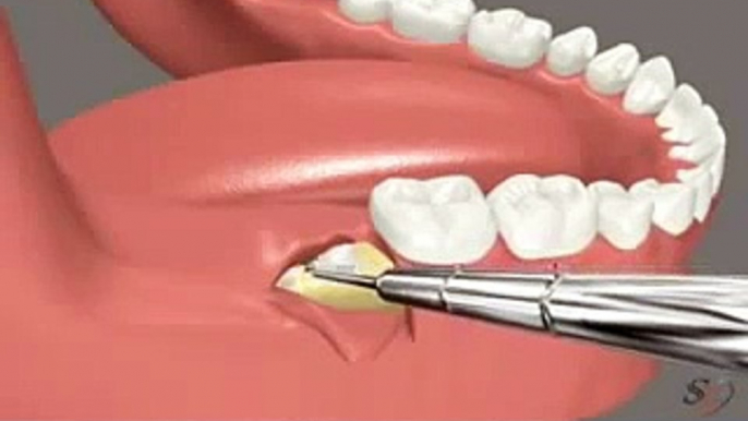 Impacted lower 3rd Molar Extraction