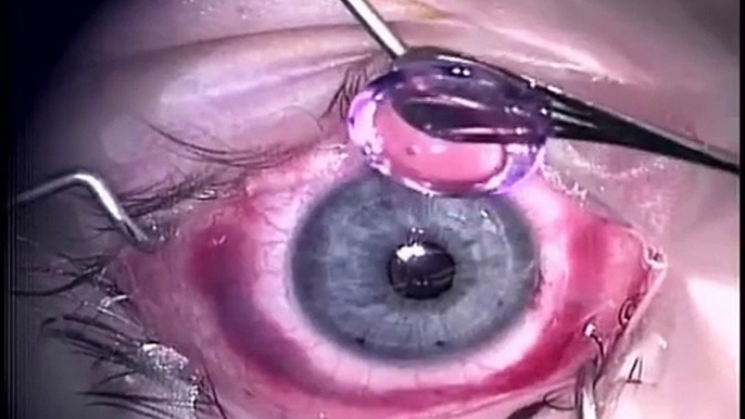 Penetrating Keratoplasty