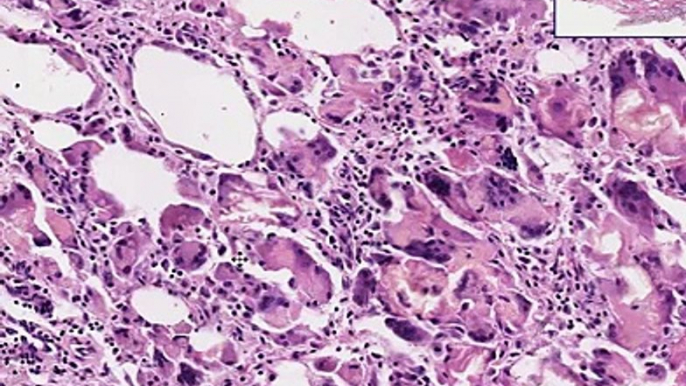 Histopathology Breast --Fat necrosis, traumatic