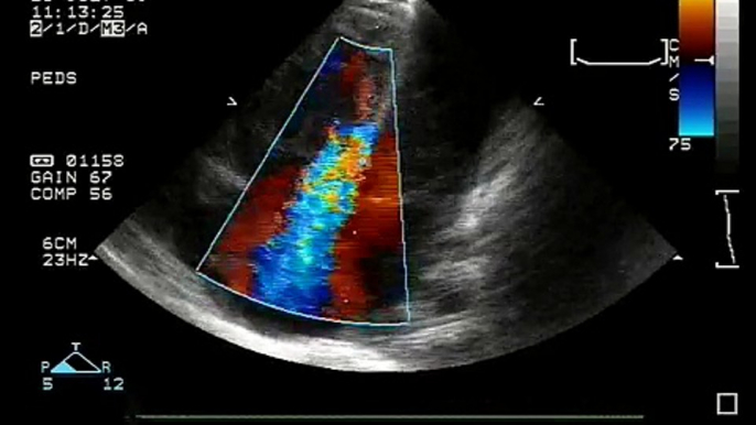 Perimembranous ventricular Septal Defect with Severe Tricuspid Regurgitation