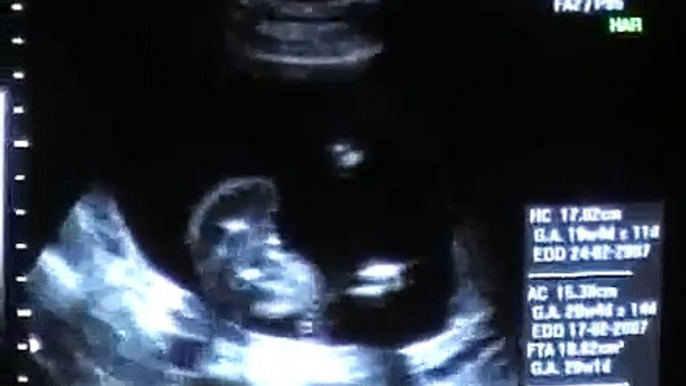 5th Month Vital Organs Ultrascan