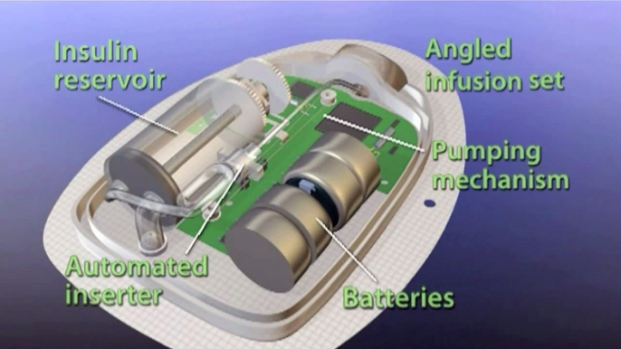 The OmniPod System - Under the Hood