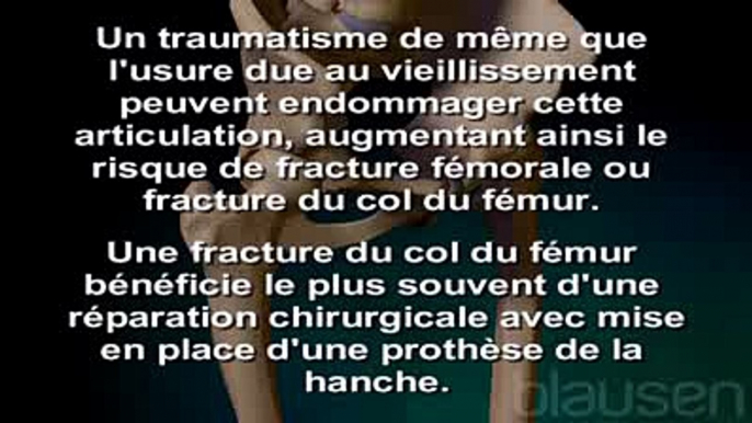 Arthroplastie de la hanche