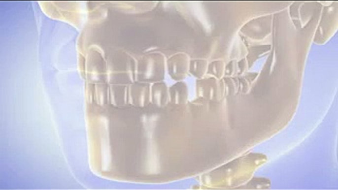 Dental implants surgery, Dental Implant procedure video by Dr Agravat Best Dental Implants Clinic Ahmedabad, India