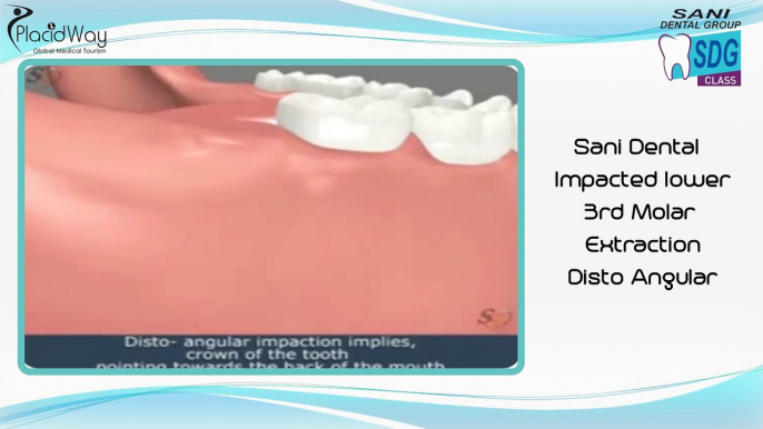 Sani Dental - Impacted lower 3rd Molar Extraction