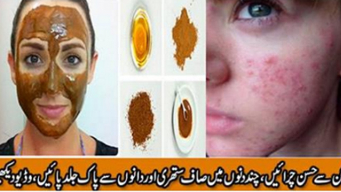 Anti Acne Honey And Cinnamon Mask for Face Pimples