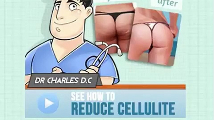 Cellulite Factor,Cellulite removal with Cellulite Factor