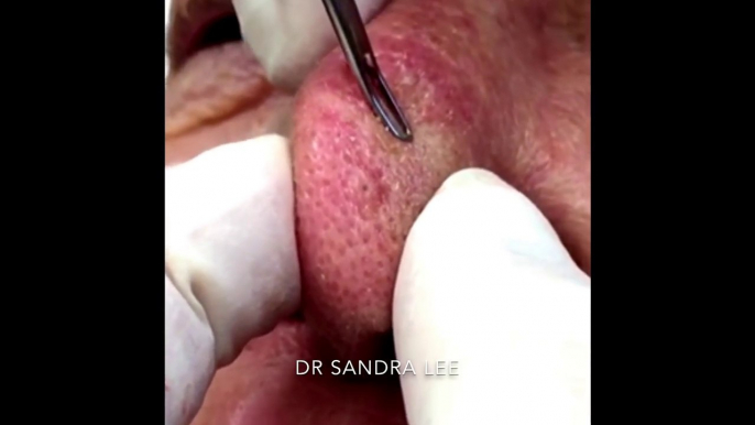 Blackhead Extractions. Nothin  but the nose. For medical education- NSFE.