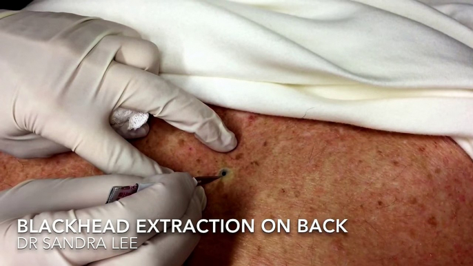 Blackhead on the back. For medical education- NSFE.