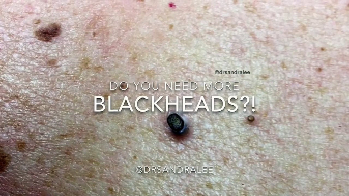 A big blackhead and some seborrheic keratoses treated on the back