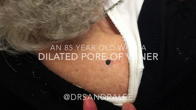 A giant blackhead extracted in an 85 y.o accompanied by her daughter.