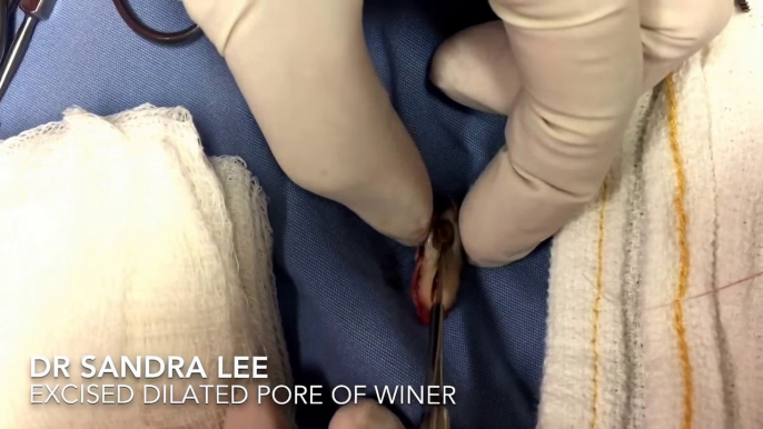 A Milia Medley, then a Dilated Pore of Winer. For medical education- NSFE.