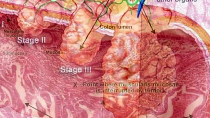 Colorectal cancer description