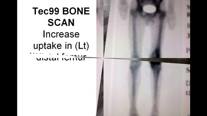 Fortnightly Meeting Case-2 OSTEOSARCOMA Dr Saghir Hussain-6th Jan 2011.avi