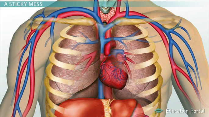 Cystic Fibrosis: Cause, Progression, and Treatment