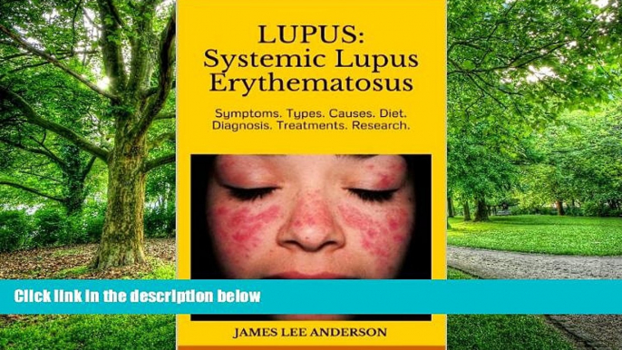 Big Deals  LUPUS:  Systemic Lupus Erythematosus: Symptoms. Types. Causes. Diet.  Diagnosis.