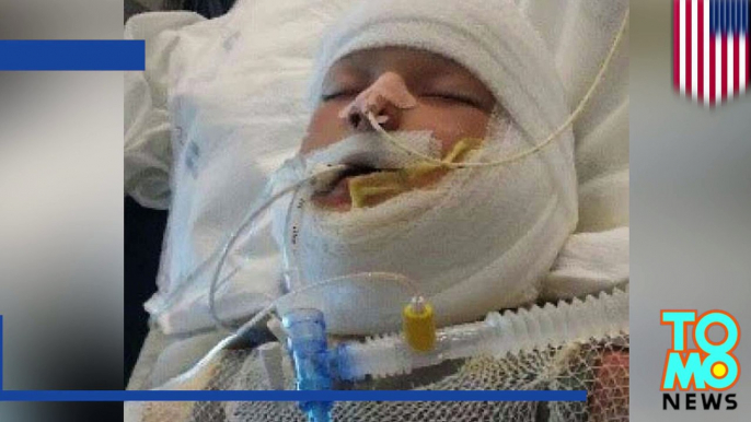 Bullies set 10-year-old special needs boy on fire with gasoline