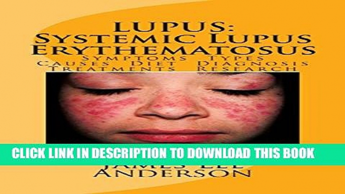 Collection Book LUPUS:  Systemic Lupus Erythematosus: Symptoms. Types. Causes. Diet.  Diagnosis.