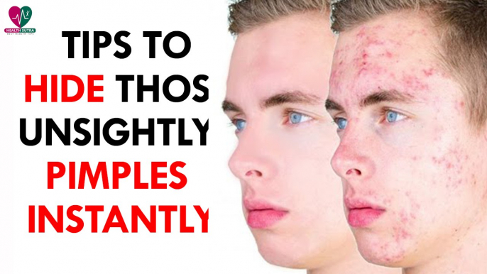 Tips to Hide those Unsightly Pimples Instantly- Health Sutra