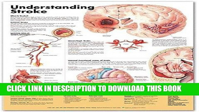 [FREE] EBOOK Understanding Stroke Anatomical Chart ONLINE COLLECTION