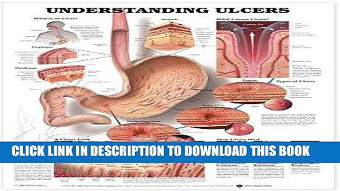 [READ] EBOOK Understanding Ulcers Anatomical Chart ONLINE COLLECTION