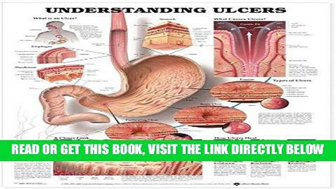 [FREE] EBOOK Understanding Ulcers Anatomical Chart ONLINE COLLECTION