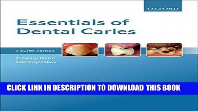 Read Now Essentials of Dental Caries PDF Book