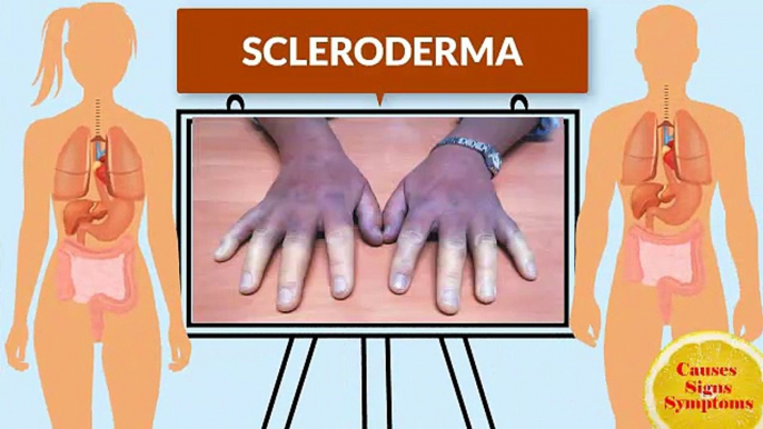 Causes Signs Symptoms Youtube Channel - Scleroderma Causes