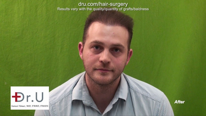 "Dr Umar Did Not Restore My Hair, He Restored My Life!" - DrUGraft Revolution Hair Transplant Repair