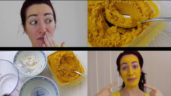 HOW TO FADE ACNE SCARRING With TURMERIC! Home Remedy For Acne & Oily Skin