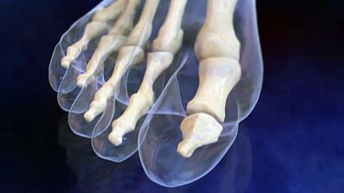 L'oignon de pied, l'hallux valgus expliqué en vidéo