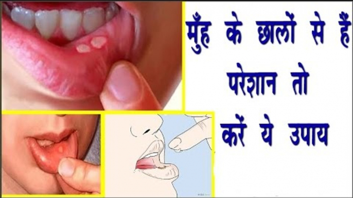 मुँह के छालों से है परेशान तो करें ये उपाय || Remedy To Treat Mouth Ulcer || Arogya India