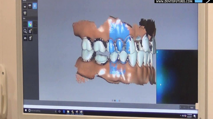 #IDS2017 : le scanner intra oral CS3600 sur le Stand Carestream Dental