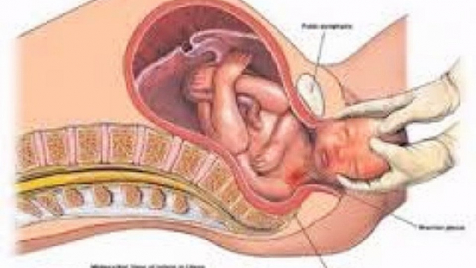 erb's palsy-causes-symptoms-appearance-affects