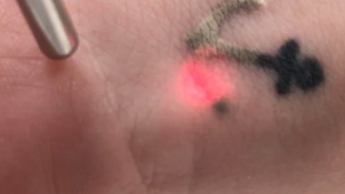 The science behind laser tattoo removal [Mic Archives]